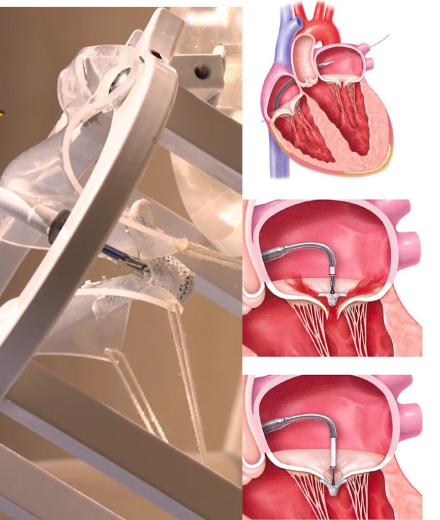 Mitra Clip修補手術是醫生在病人大腿引入導管(一根幼長的軟性管子)，將一個「手指尾大小」的金屬夾子MitraClip裝置引導至心臟，再夾住鬆脫的二尖瓣，令其能完全緊閉。