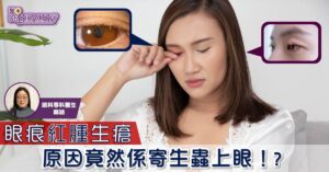 眼痕紅腫生瘡 原因竟然係寄生蟲上眼！