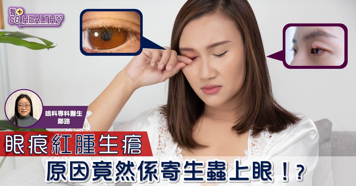 眼痕紅腫生瘡 原因竟然係寄生蟲上眼！