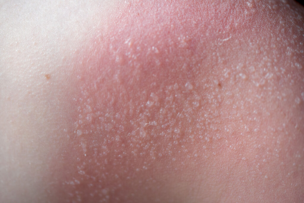 嚴重曬傷會感強烈痛楚、紅腫、脫皮、發炎，同時出現大面積水泡或發燒嘔吐等情况，皮膚等同嚴重灼傷，一旦出現上述症狀，建議最好立即就醫治療。