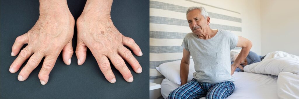 關節畸形可令患者活動受阻；發炎性關節炎患者在起床後半小時內會感到關節僵硬