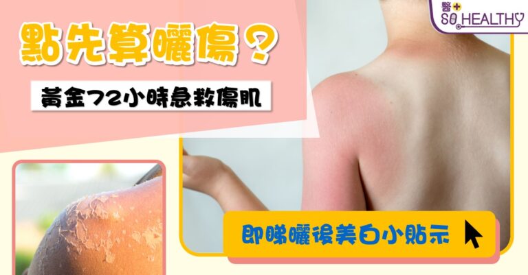 曬傷急救7招 切忌急於美白 金銀花白菊花有助紓緩