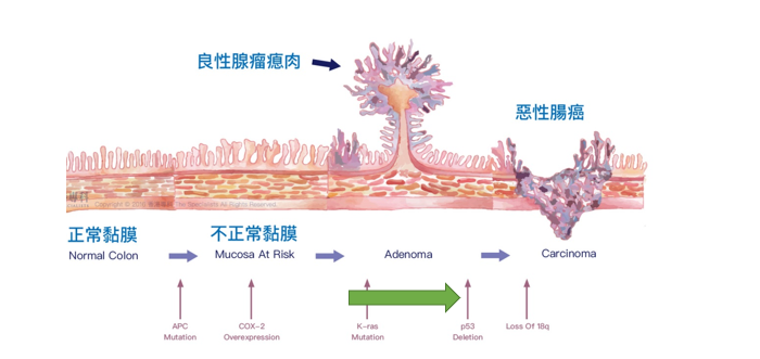 瘜肉與大腸癌息息相關，當腺瘤瘜肉發生癌變便會慢慢演變為癌症