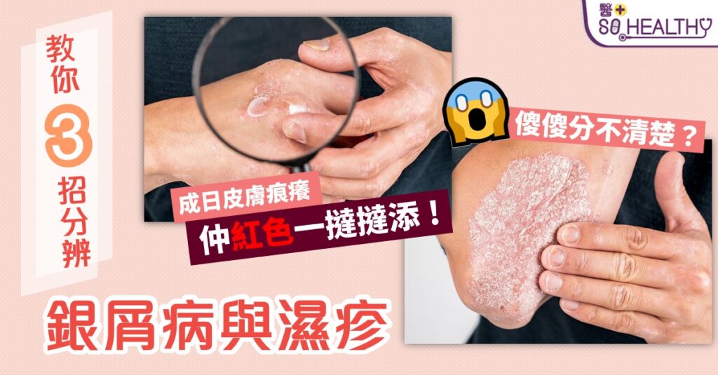 3招分辦銀屑病定濕疹 4款湯茶改善皮膚又乾又痕