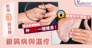 3招分辦銀屑病定濕疹 4款湯茶改善皮膚又乾又痕