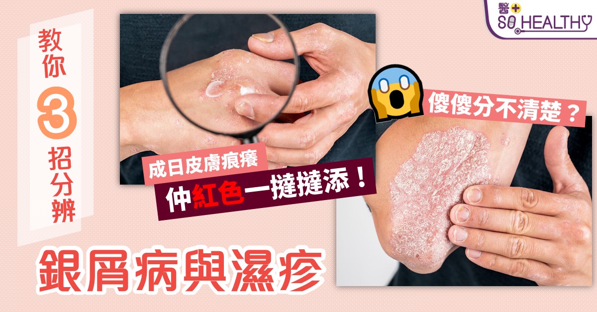 3招分辦銀屑病定濕疹 4款湯茶改善皮膚又乾又痕