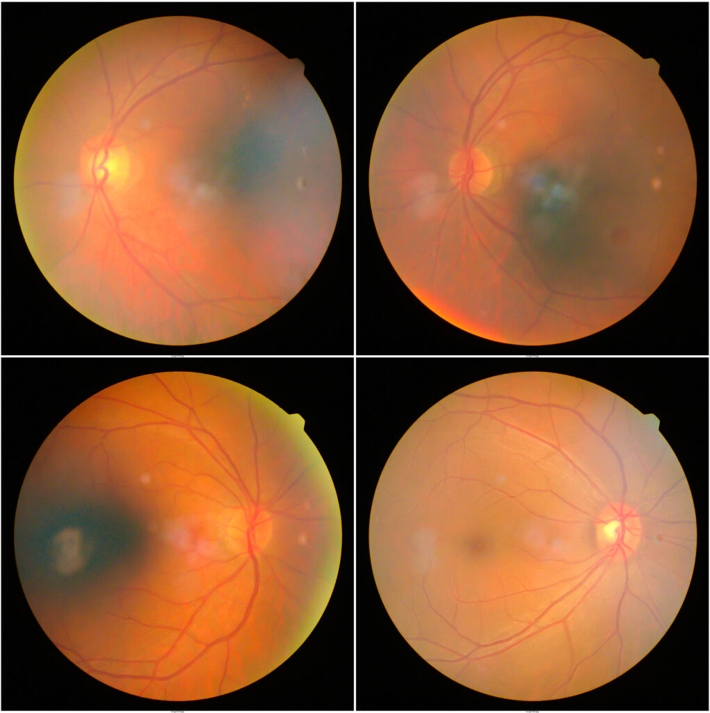血糖過高，容易傷害血管及引致血管滲漏，以至視網膜細胞的養分及氧氣供應不足，導致「糖尿視網膜病變」，俗稱「糖尿上眼」