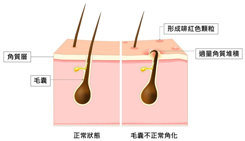 毛囊角化令皮膚出現紅色一粒粒