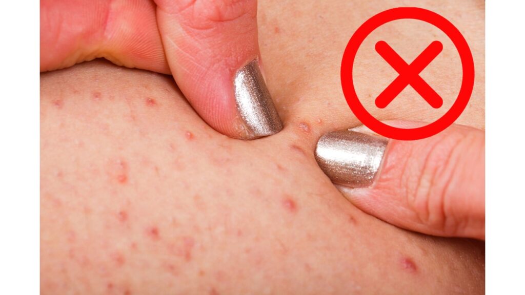 毛囊角化患者切勿擠壓患處