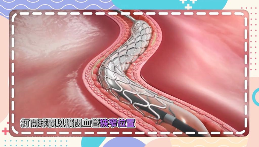 ▲經過微型的導管將球囊放在心臟血管的狹窄位置，然後打開球囊以擴闊血管。