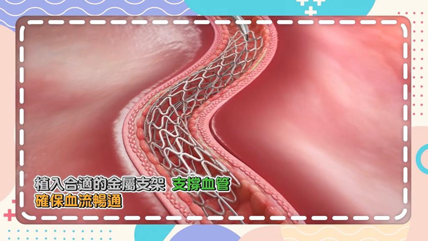 ▲醫生會選擇一個合適的金屬支架植入心臟血管處，確保血流暢通。