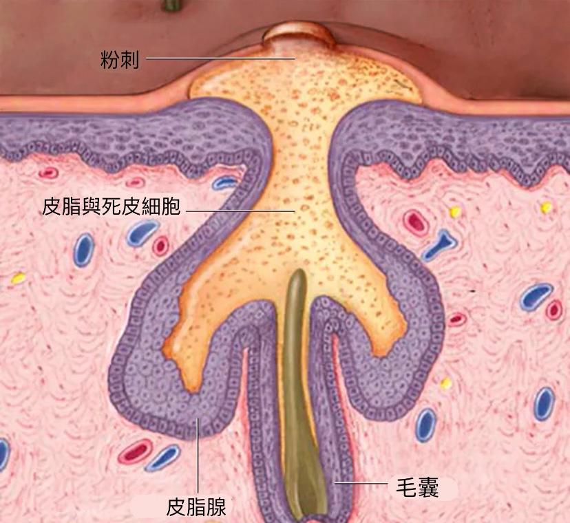 皮脂導致毛孔堵塞，形成暗瘡。