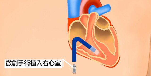 微型無導線起搏器可以經微創方法直接安裝於心臟內，令表面不留安裝痕跡。