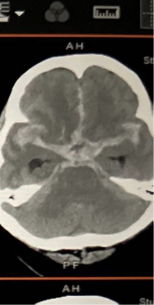 急性蜘蛛膜下腔出血和急性腦積水的電腦掃描。